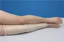 Alimed Protective Leg Tube DermaSaver™ X-Large - M-733401-2104 - Each