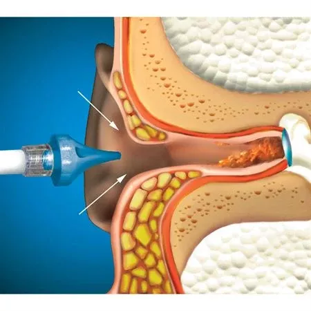 OtoClear Ear Irrigation Tip and Systems OtoClear Ear Spray Wash Kit