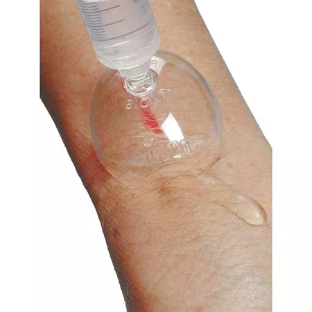 Wound Irrigation Shields Wound Irrigation Shield